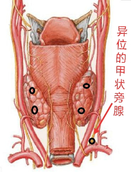 異位甲狀旁腺_副本.jpg