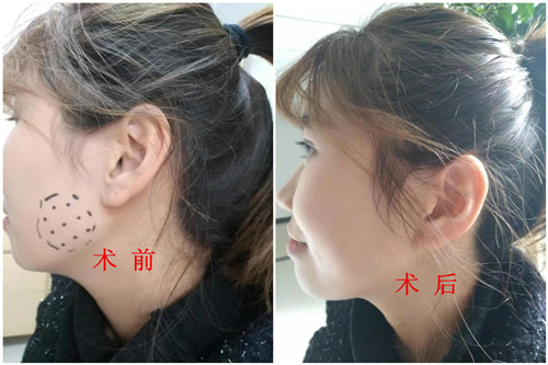術前術后對照_副本.jpg