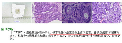 術后病理_副本.jpg